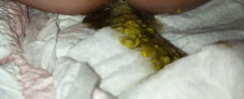 Loose greenish poop na parang may sipon