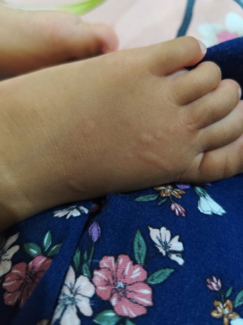 Gatal seperti biduran