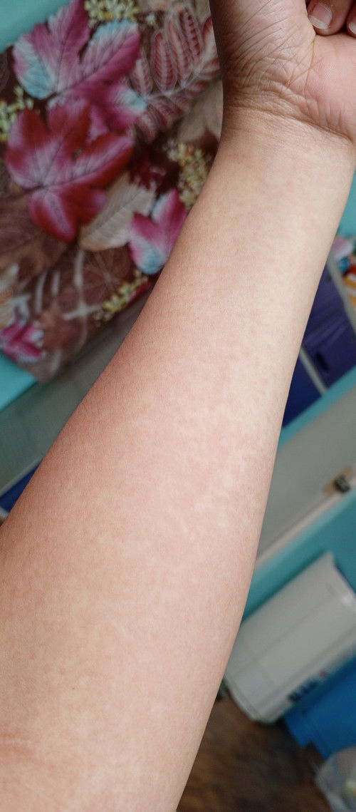 okay lang ba mag ogtt kahit may allergy?