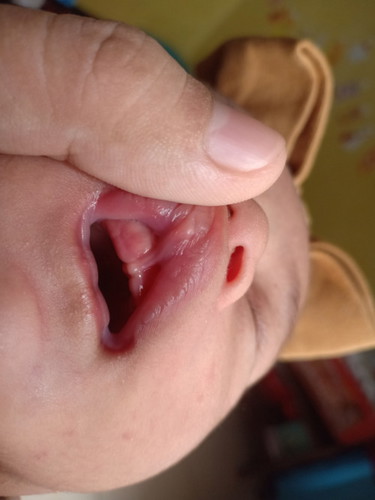 Liptie atau bukan