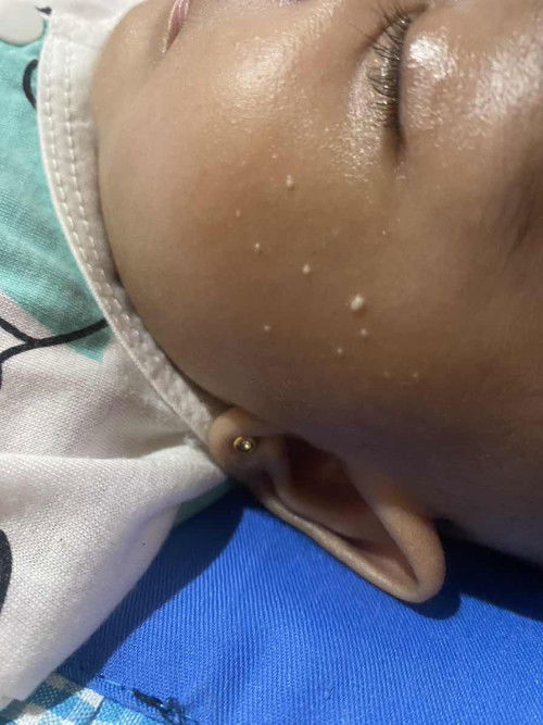 Kulit bayi bruntusan