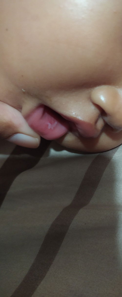 mulut dalam anak terluka berdarah