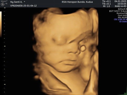 Tanya dong bun klo steril apa sekalian sesar