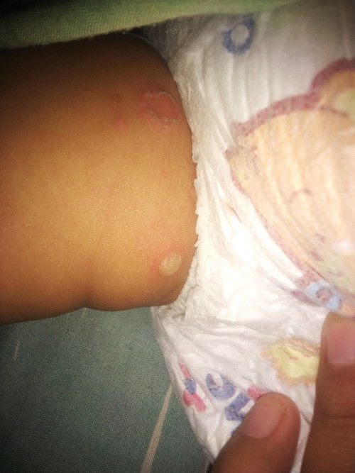 Ruam popok bentol isi air nanah