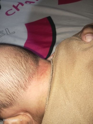 Bayiku usia satu bulan lebih tapi kok ada merah merah gini knpa ya bun?ada yg tau boleh dong komen