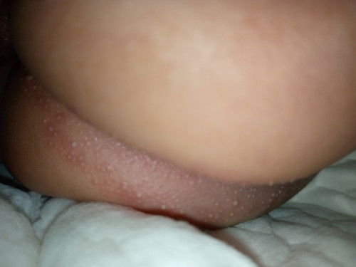 Bagaimana cara mengobati ruam popok