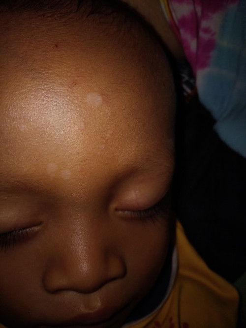 putih pada muka bayi usia 19bulan