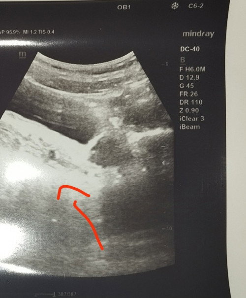 kantung kehamilan atau bukan?
