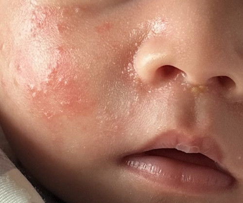 Ruam di wajah bayi