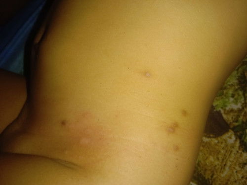 Bentol menjadi kecoklatan pada kulit