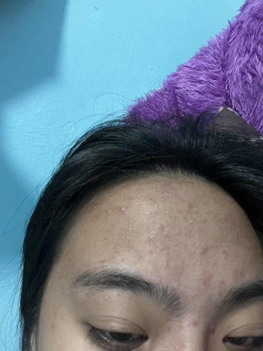 สิวขึ้นเยอะมาก