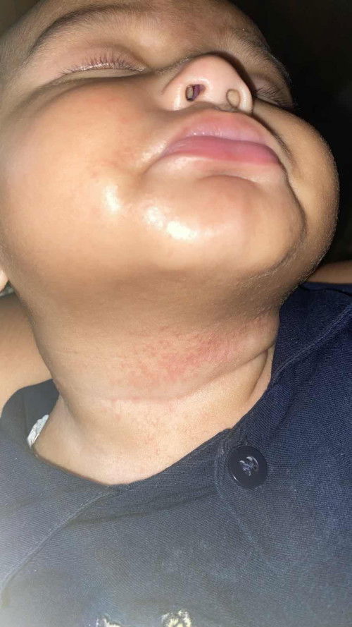 Info obat bayi bintik bintik merah