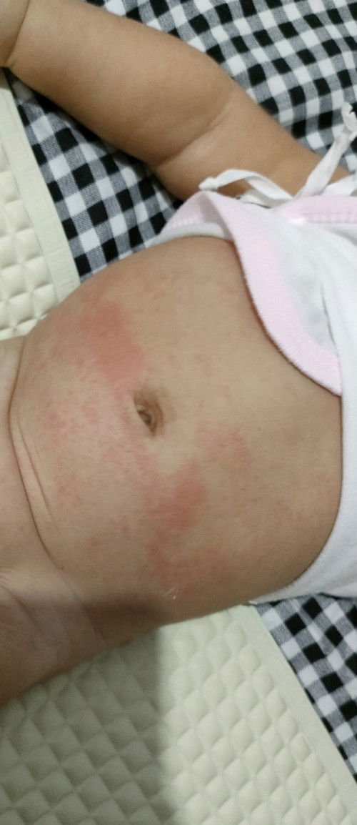 Diaper Rash lang ba?