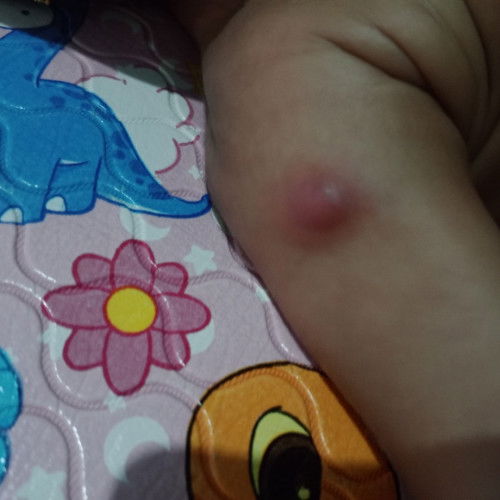 Hbis di suntik 1bln umur mau 3bln jadi bisul besar bgt gimna cara nyembuhinya yh? kasian takut sakit
