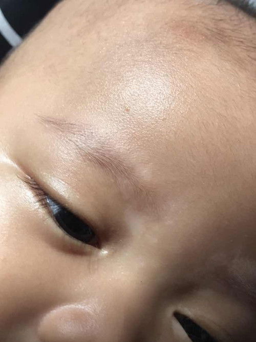 Bercak putih di wajah bayi