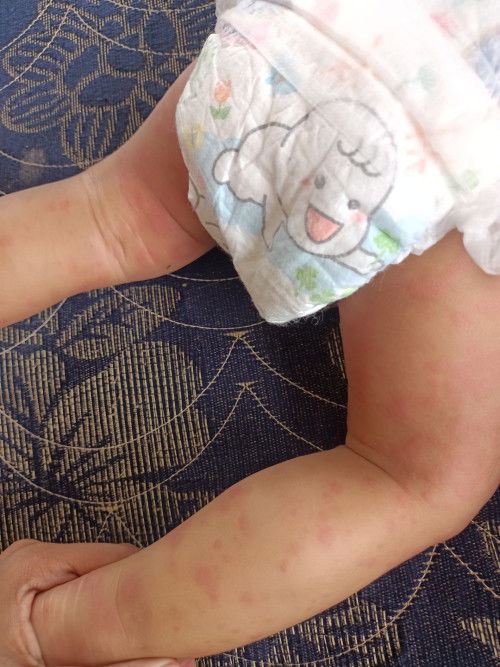 Muncul merah seluruh tubuh setelah demam