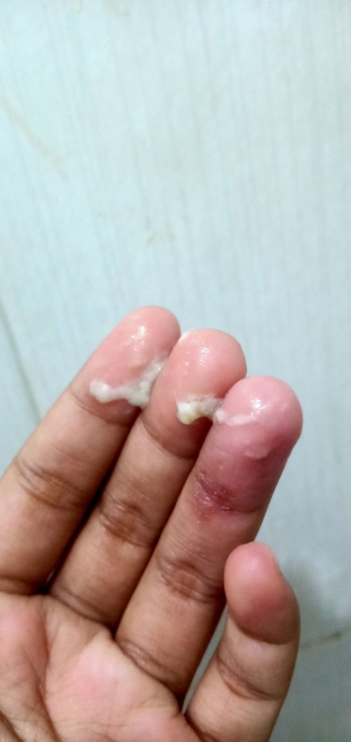 normalkah keputihan seperti ini, kaya gumpal gitu trus bau nya kaya susu gitu