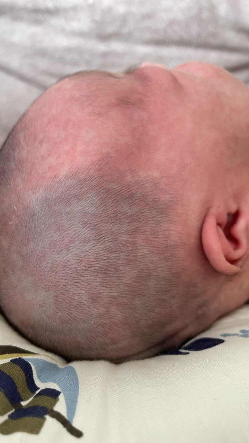 Baby skin rashes normal ke?