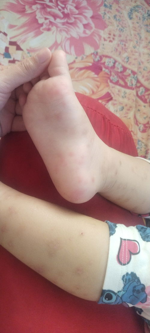 Hi mommies, suggest naman po ng gamot sa rashes ng baby 7x na kaming bumabalik sa pedia and derma.