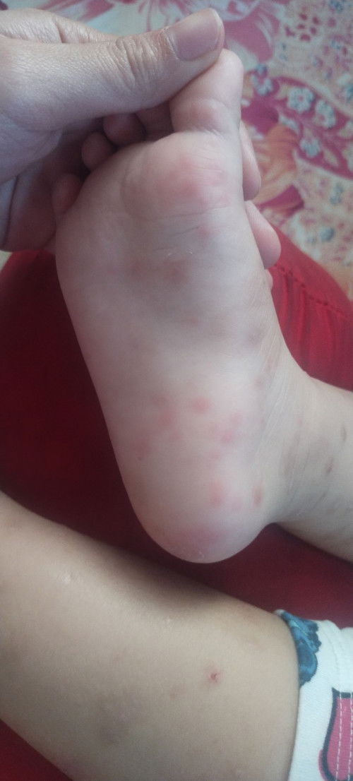 Hi mommies, pasuggest naman po ng mga ointments/meds sa baby rashes. 7x napo kaming bumabalik sa doc