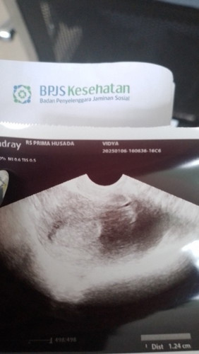 Di testpek negatif tapi hasil usg seperti ini apa bisa hamil?