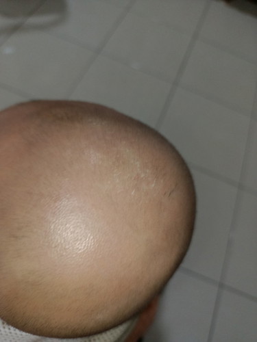 Kulit kepala baby kering