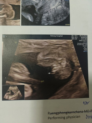 แบบนี้ลูกสาวชัวร์ 100%ไมค่ะ แม่แอบกลัวน้องเปลี่ยนทีม 😊😊 ที่บ้านทีมชาย2คนแล้วค่ะ