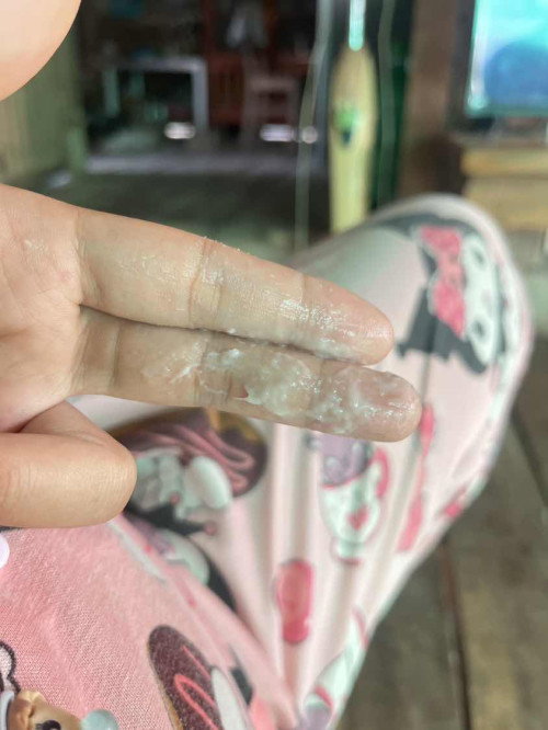 ตกขาวตอนท้องแบบนี้คือตกขาวอะไรคะ