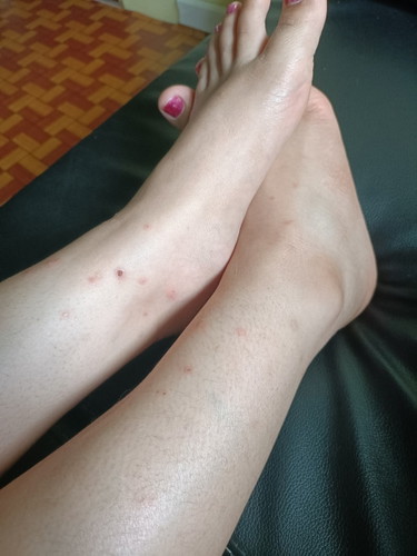 Kaki Badan Tangan naik gatal