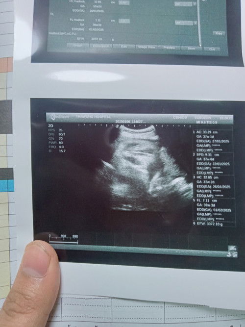 แม่ๆว่าผญหรือช คะวันนี้นัดซาวสุดท้าย ถามว่าอยากได้ ญรึ ช แม่บอก ญ คะแล้วหมอบอกดูจากผลหมอมีแนวโน้ม ญ