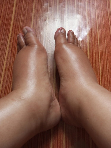 Kaki bengkak