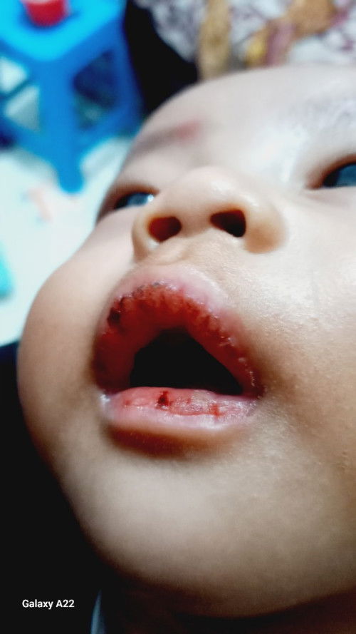 Bibir pecah pecah sampai keluar darah karena dibuat nangis