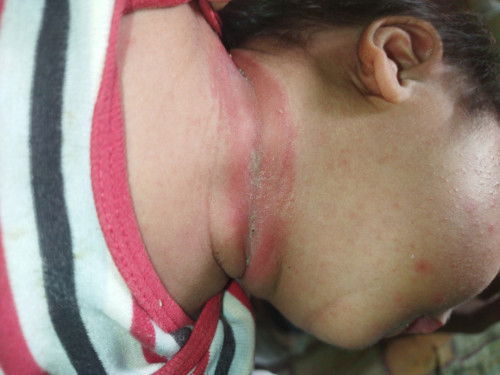 Leher merah dan berbau