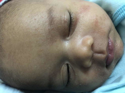 pipi dan leher anak merah dan kering
