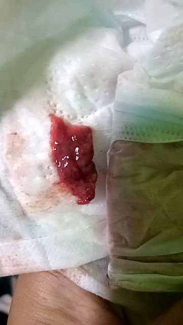 ท้อง6+3weekมีเลือดไหลเป็นก้อน