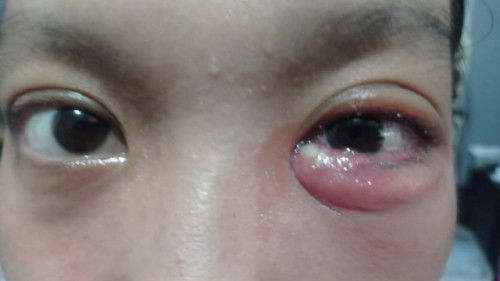 Mata luka kalo ke RS tanpa rujukan bisakah pake BPJS?