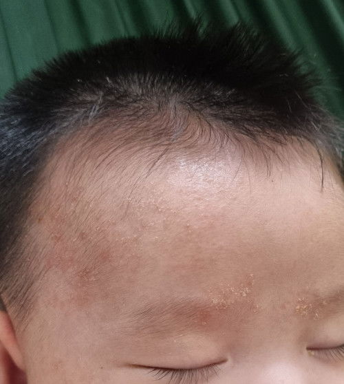 Hỏi về vấn đề da của bé