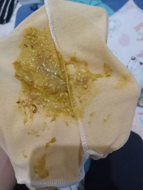 Pup bayi 5 bulan ada serat hitam full asi