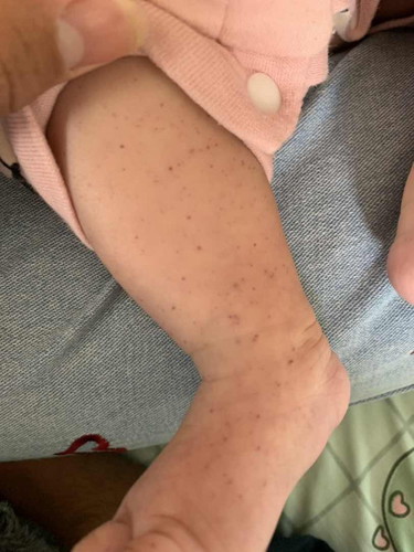 สอบถามแม่ๆหน่อยค่ะ มีลูกบ้านไหนเป็นแบบนี้บ้างมั้ยคะ เหมือนจะเป็นจ้ำเลือด เกิดจากอะไร จะหายไปเองไหม