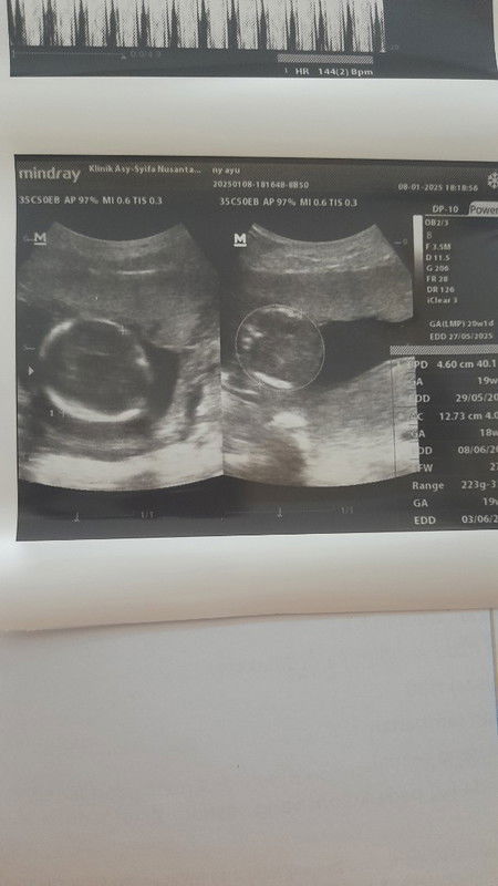 Hasil usg 19 minggu