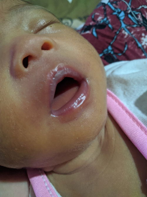 Seperti sariawan dan panas dalam