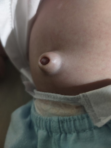 Pusod umaangat PAG umiiyak SI baby