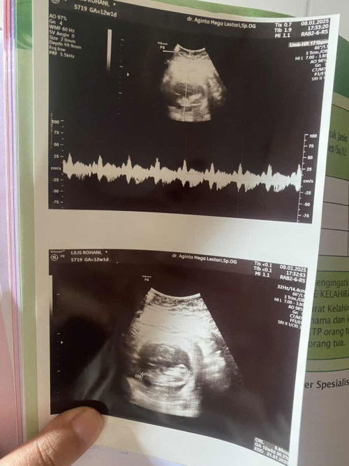 Usia kehamilan 12minggu