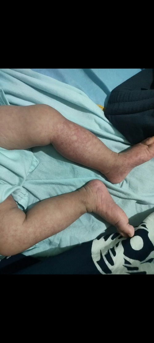 Mau tanya kok kira kira ini kenapa yaa  ? Kaki anak ku merah