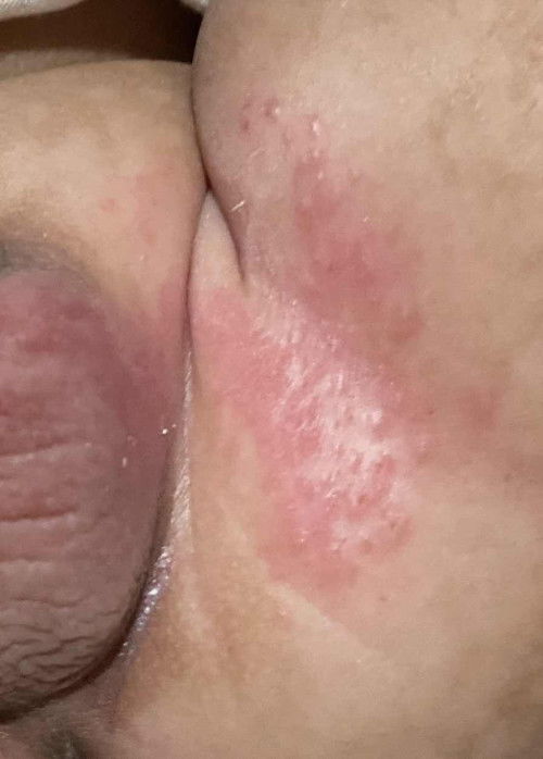 Merah2 ruam gini di sekitar kemaluan dikasih apa ya bun?