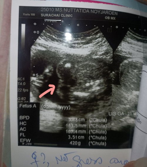 ผลอัลตร้าซาวด์