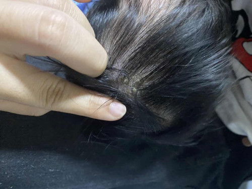 หนังศีรษะลูกเป็นแบบนี้เกิดจากอะไร