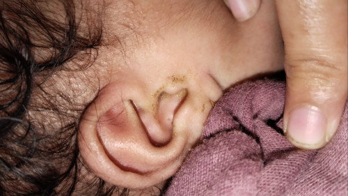 Telinga Keluar cairan