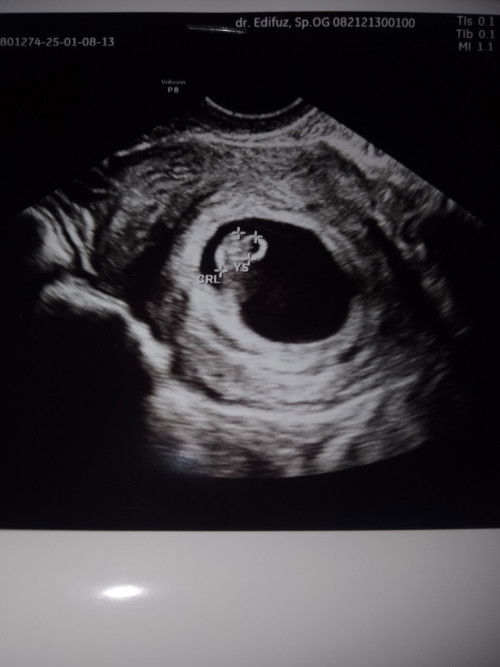 Usia janin berbeda saat di USG