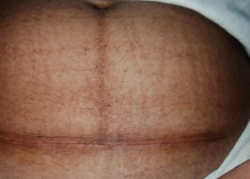 bekas operasi Caesar